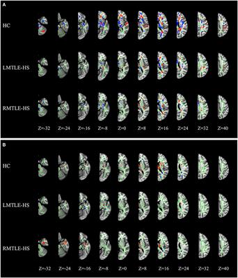 Reduced Interhemispheric White Matter Asymmetries in Medial Temporal Lobe Epilepsy With Hippocampal Sclerosis